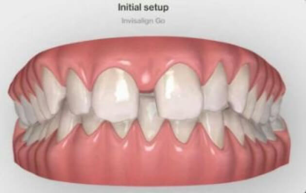 Reporter Ben Jolley is beginning his teeth transformation journey with Invisalign treatment by Dr Kishan Patel at March Dental Surgery. This photo shows what his teeth look like currently. Picture: INVISALIGN