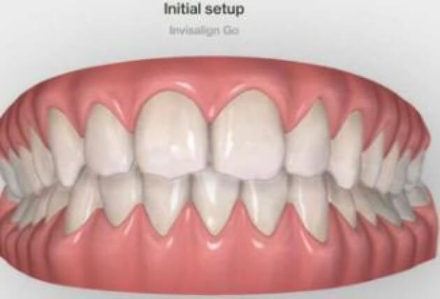 Reporter Ben Jolley is beginning his teeth transformation journey with Invisalign treatment by Dr Kishan Patel at March Dental Surgery. This photo shows what his teeth will look like after the treatment. Picture: INVISALIGN