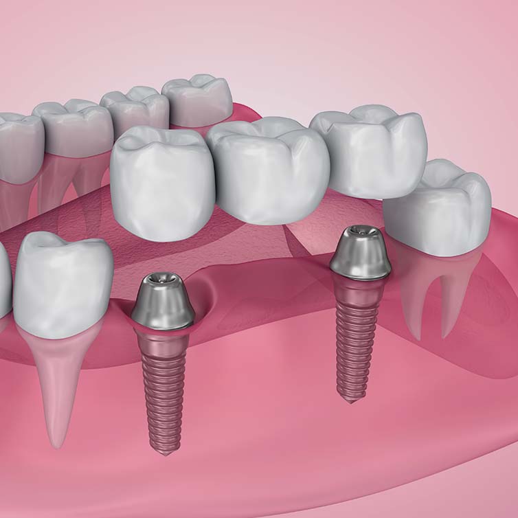 Treatment - March Dental