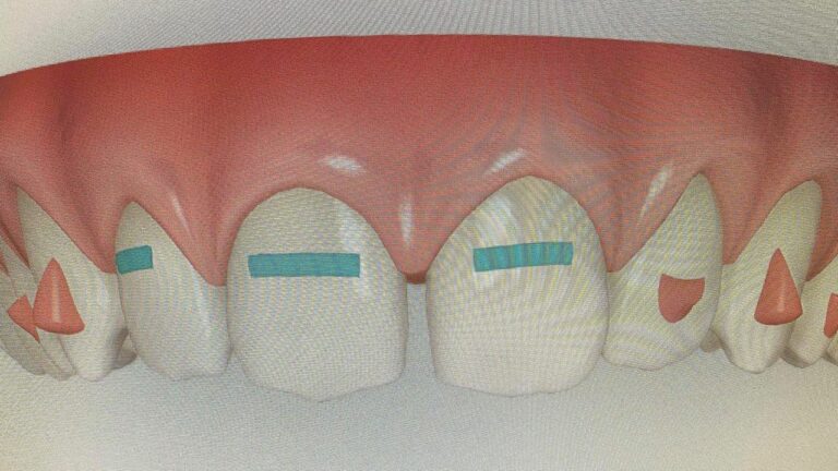 Reporter Ben Jolley’s teeth six weeks into Invisalign treatment. – Credit: MARCH DENTAL SURGERY